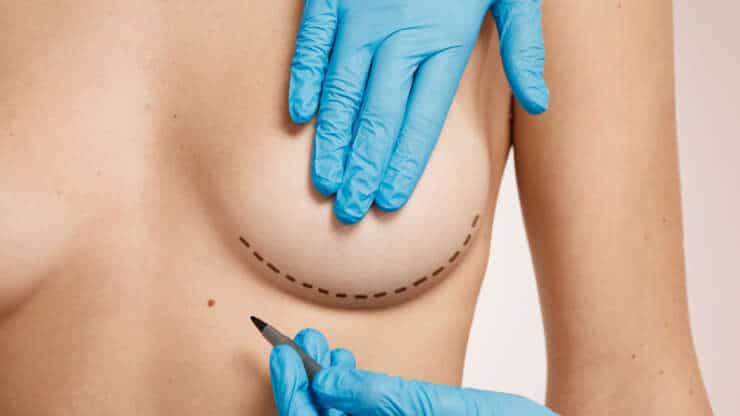 Augmentation mammaire par prothèses : tout savoir avant de se lancer