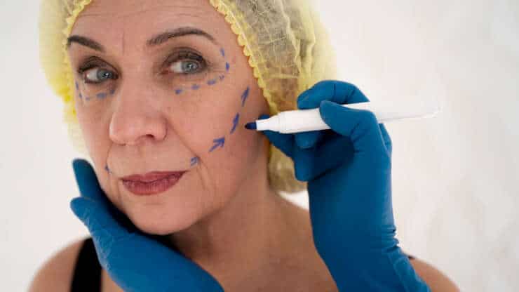 Fils tenseurs non résorbables : une alternative au lifting chirurgical